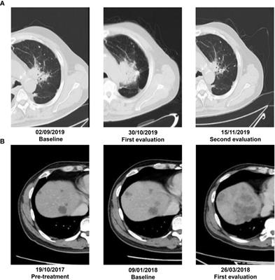 CT-Based Peritumoral and Intratumoral Radiomics as Pretreatment Predictors of Atypical Responses to Immune Checkpoint Inhibitor Across Tumor Types: A Preliminary Multicenter Study